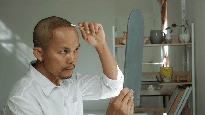 Quanto tempo demora pro cabelo da área transplantada começar a crescer? Transplante capilar é definitivo?